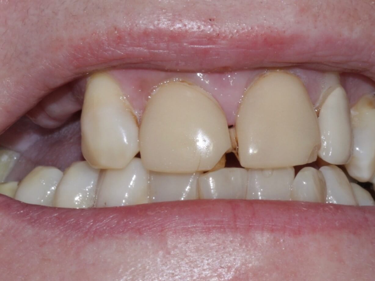 Veneers and private denture