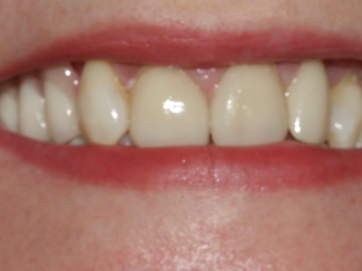 Veneers and private denture