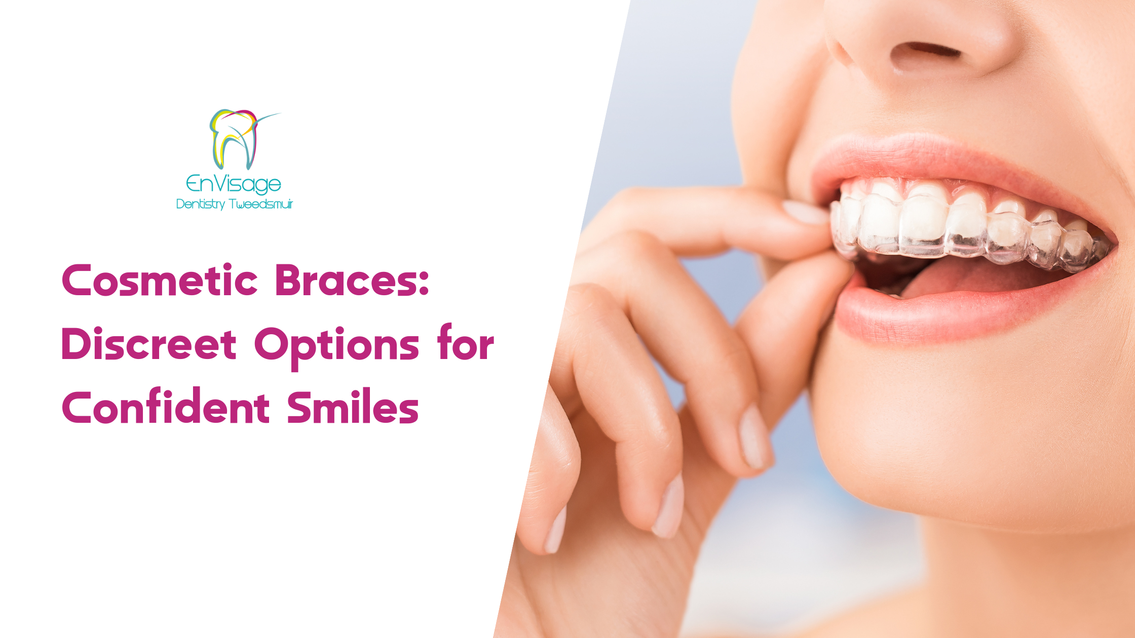 Cosmetic Braces_ Discreet Options for Confident Smiles Cosmetic Braces: Discreet Options for Confident Smiles